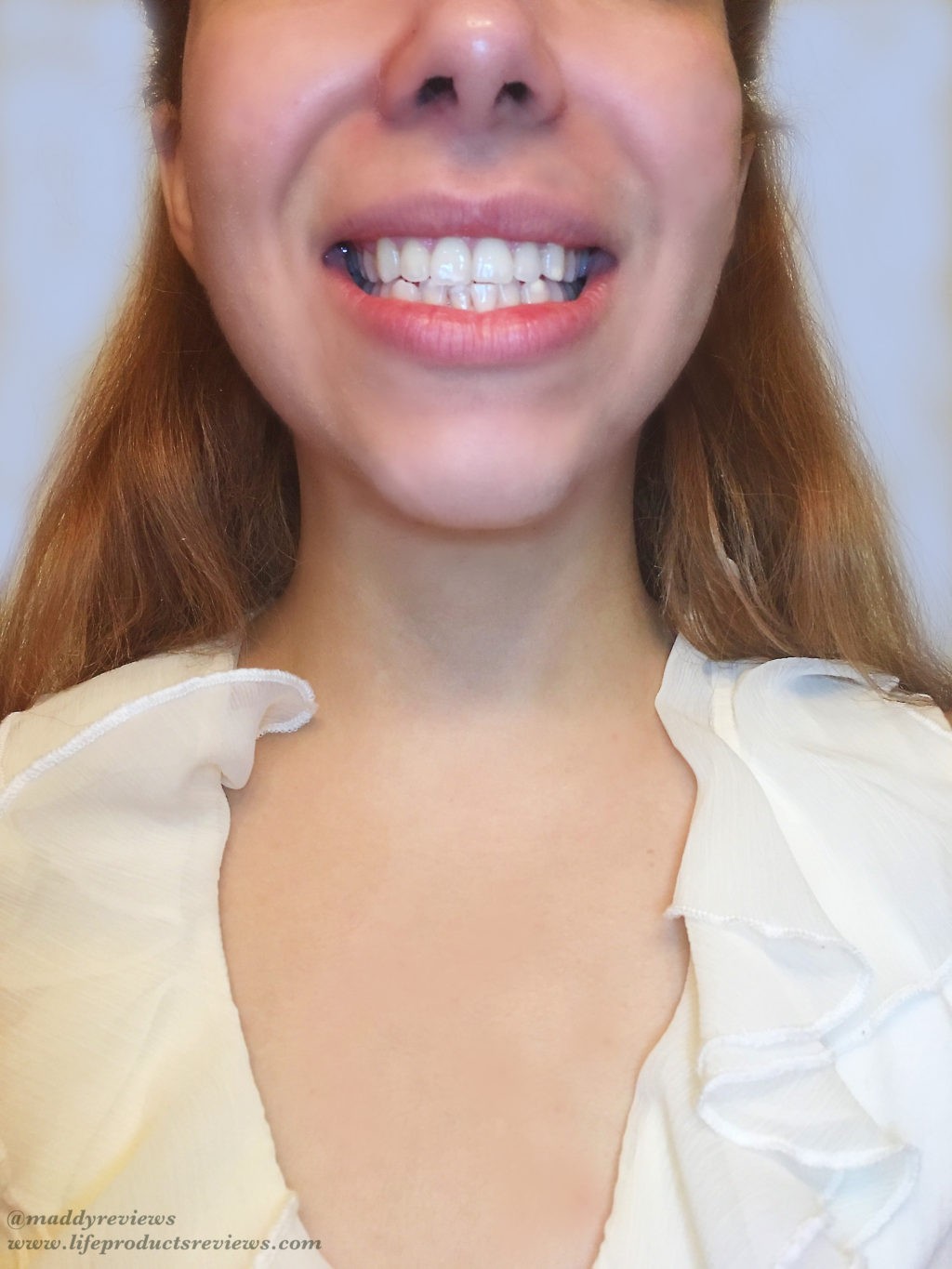 After-yellow-stain-teeth-results-front-smile-brilliant-pearly-whites-whitening-effect.jpg