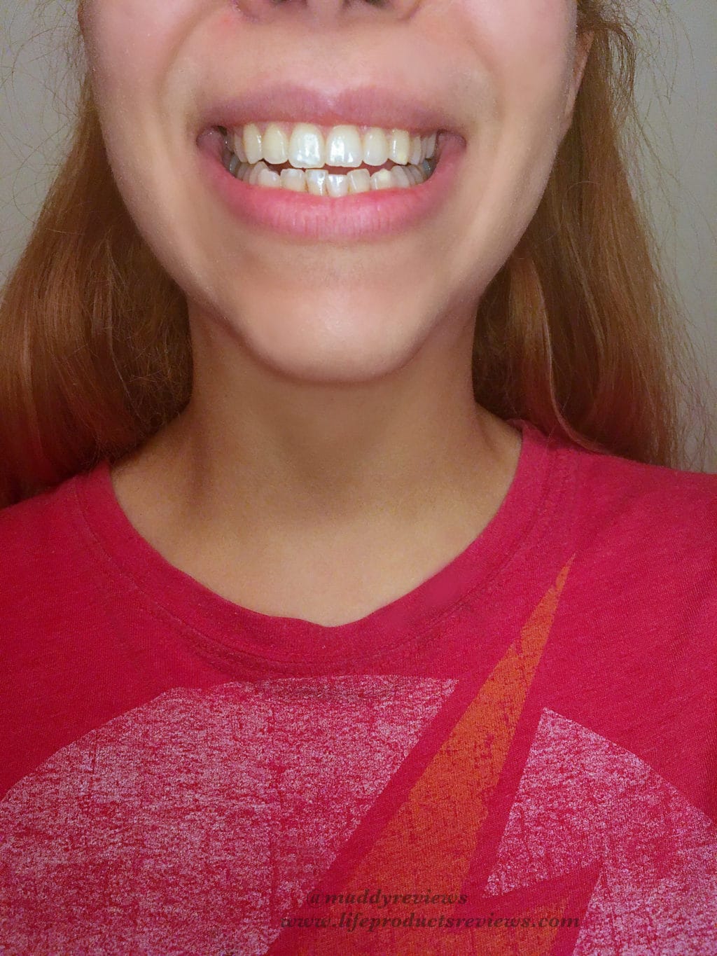 Front-teeth-yellow-stain-before-using-whitening-gel-kit